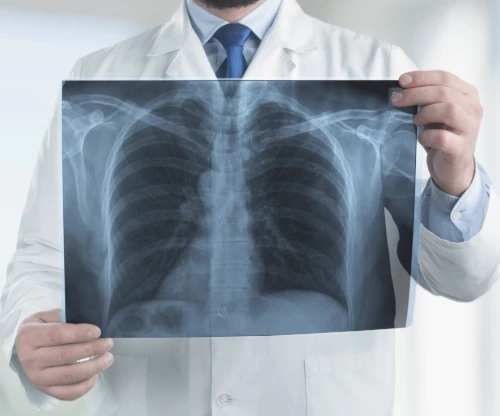 Médico revisando radiografía de un paciente con enfermedad pulmonar obstructiva crónica